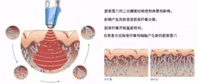減肥/抗衰兩不誤，BTL溶脂刀儀器一次滿足你