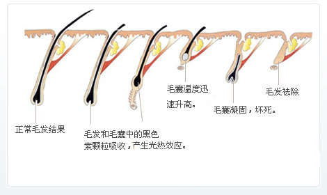 脫毛為什么一次性脫不干凈？原因在這里