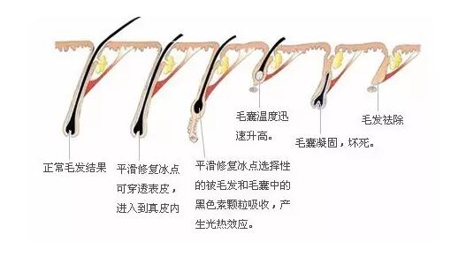 為何OPT脫毛儀能在美容儀器中獨占鰲頭？