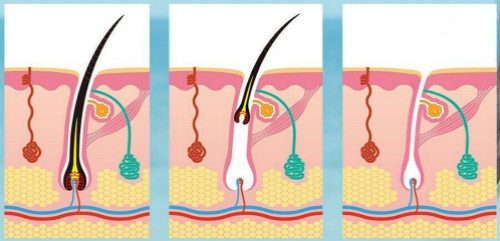 毛發(fā)生長(zhǎng)周期 毛發(fā)生長(zhǎng)周期