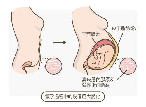 一文秒懂！妊娠紋肥胖紋保養(yǎng)、治療及預(yù)防全攻略