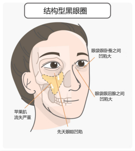 區(qū)分黑眼圈！黑眼圈的成因、分類、預(yù)防與治療全攻略