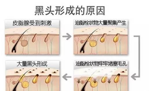 美容儀器廠家教您如何快速祛除黑頭？