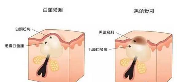 美容儀器廠家教您如何快速祛除黑頭？