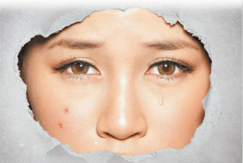 拒當「痘花妹」！看痘痘生長的位置判斷也許是身體出了問題