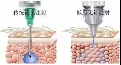 水光針和無(wú)針?biāo)獾降啄膫€(gè)效果好？