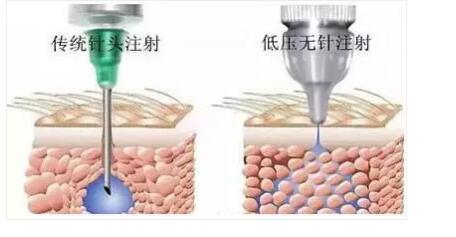 無創(chuàng)水光美容儀可以替代水光針治療嗎？