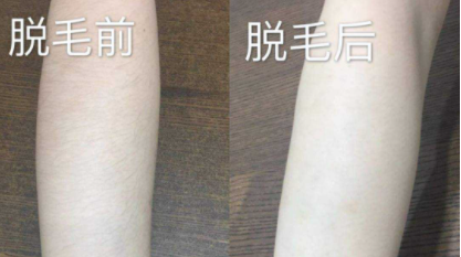 怎樣真確使用脫毛儀，脫毛儀廠家告訴你